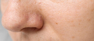 What are Pore Clogging Ingredients?