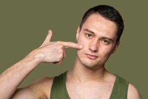 How Do You Treat Adult Acne?