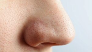 Blackheads