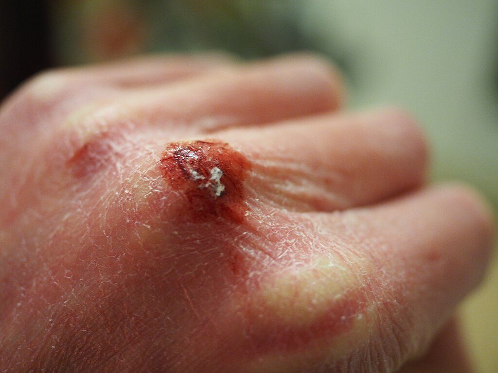 What is Eczema?