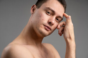 What Causes Adult Acne